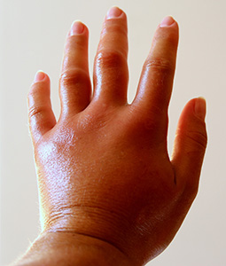 <p>Edema-</p>