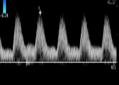 <p>where does the doppler tracing most likely come from in the body?</p>