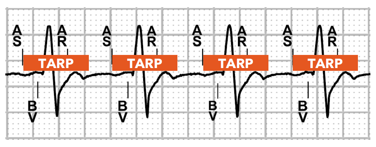 <p>when the atrial rate reaches the Total Atrial Refractory Period (TARP) value</p>