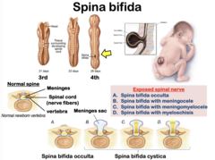 <p>1. Spina bifida occulta</p><p>2. Spina bifida with meningocele</p><p>3. Spina bifida with meningomyelocele</p><p>4. Spina bifida with myeloschisis</p>