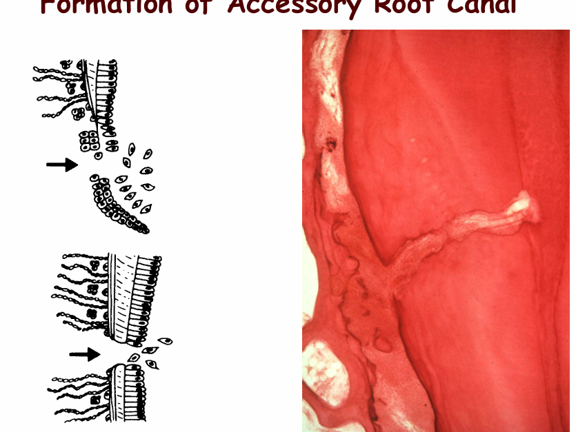 <p>A small lateral canal – connecting the PDL with the main root canal</p><ul><li><p>Formed if epithelial root sheath breaks down before root dentin is formed => no hers to induce dental pulp cells to odontoblast=> no root dentin formation</p></li><li><p>anywhere along root</p><ul><li><p>typically apical third/furcation of teeth</p></li></ul></li></ul><p></p>