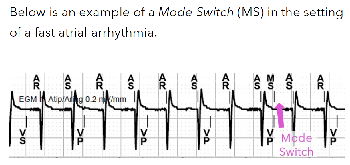 <p>occurs when the device detects the onset of an atrial tachyarrhythmia</p><p>Upon detection, the device switches to DDIR. It gradually adjusts the ventricular pacing rate from what it was during tracking, towards the device-determined Sensor Rate</p>