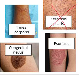 <ul><li><p>Psoriasis</p></li><li><p>Dermatitis</p></li><li><p>Tinea Corporis</p></li><li><p>Some congenital nevi</p></li></ul><p></p>