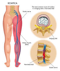 <p>Summerize the <strong>sciatic nerve</strong>.</p>