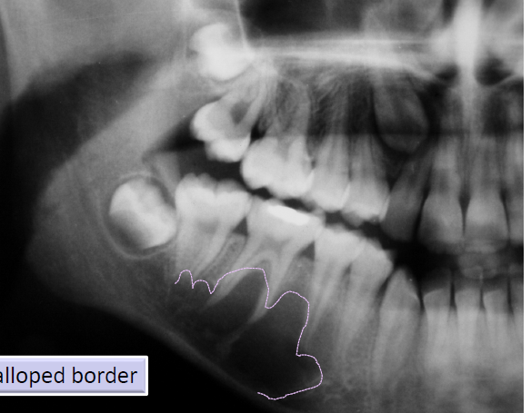 <ul><li><p>asymptomatic intra-osseous empty cavity</p></li><li><p>not a true cyst</p></li><li><p>may be associated with trauma, patients commonly young </p></li><li><p>pseudocyst</p></li><li><p>lined by a thin loose connective tissue,<strong> scalloped borders</strong></p></li></ul><p></p>