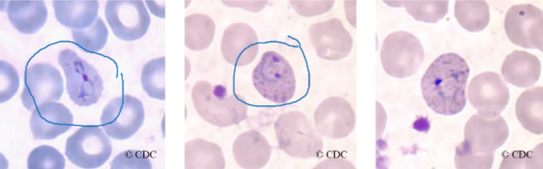 <ul><li><p><span style="background-color: transparent;">Red blood cells infected with plasmodium vivix tend to become enlarged and distorted in response to the presence of the growing parasites.</span></p></li></ul><p></p>
