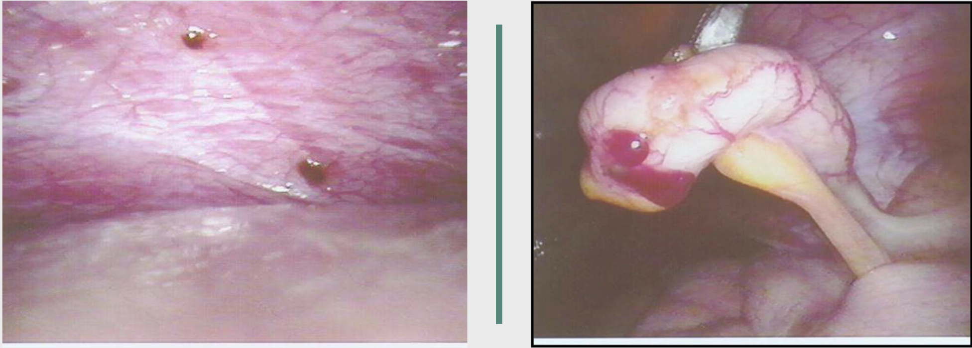 <p>Endometriosis gold standard for dx</p>