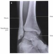 <p><mark data-color="#f36bcb" style="background-color: rgb(243, 107, 203); color: inherit;">Distal tibiofibular joint space open.</mark><br>Lateral malleolus and talus articulation with little or no superimposition.<br>Medial malleolus partially superimposed</p>