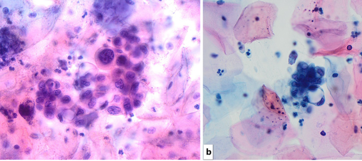 <p>effet DIU</p><p>1) cellules larges vacuolisées, pseudo-signet ring (photos)</p><p>2)</p><ul><li><p>Petites cellules à gros noyau</p></li><li><p>chromatine fine (DD HSIL)</p></li></ul><p></p>