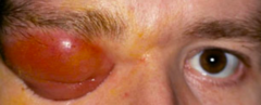 <p>Stage 1: Inflammatory edema</p><p>Stage 2: Orbital cellulitis</p><p>Stage 3: Subperiosteal abscess</p><p>Stage 4: Orbital abscess</p><p>Stage 5: Cavernous sinus thrombosis</p><p>Life-threatening**</p>