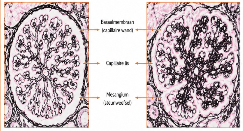 <ul><li><p>normaal</p><ul><li><p>basaalmembraan is dun en regelmatig </p></li><li><p>capillaire lissen zijn open </p></li><li><p>mesangium is normaal</p></li></ul></li><li><p>afwijkende</p><ul><li><p>BM is verdikt en onregelmatig</p></li><li><p>capillaire lissen zijn vervormd of gesloten</p></li><li><p>mesangium is proliferatief </p></li></ul></li><li><p>immunofluor kleuring voor IgG → die complexen volgen patroon van BM</p><ul><li><p>ook valt het op dat het beeld dan vrij onregelmaitg is → past bij membraneuze glomerulopathie </p></li><li><p>ook kan je spikes zien tussen podocyten en endotheel = nieuwvorming van BM → ook hint voor MG </p></li></ul></li></ul><p></p>