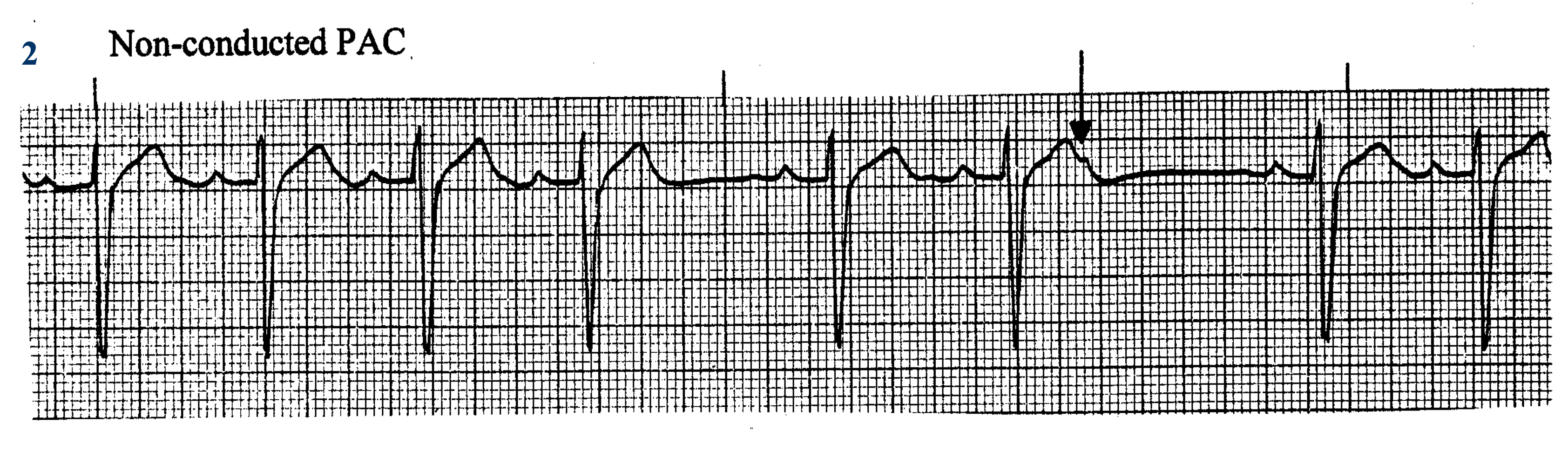 <p>What ECG is this? </p>
