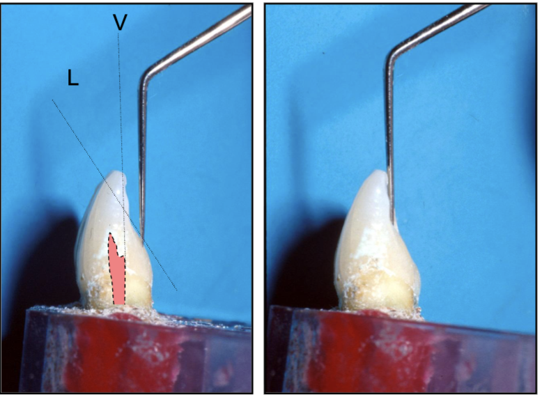 <p>determined by incisal edge and cavoangle of the lingual so that you get underneath the incisal edge to obtain straight-line access </p>