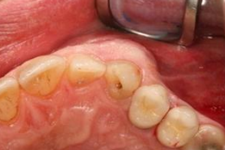 <p>A 31 year old presenting with a cystic swelling in lateral aspect between lateral incisors and canine. Provide differential diagnosis</p>