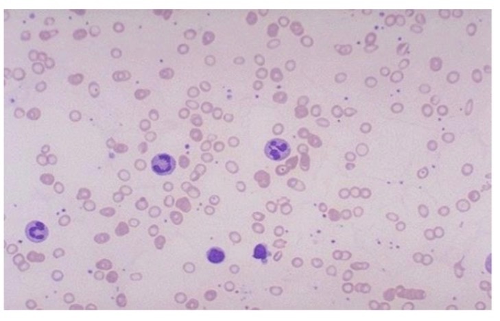<p>Low iron anemia in male who is cold, pale, and fatigued </p>