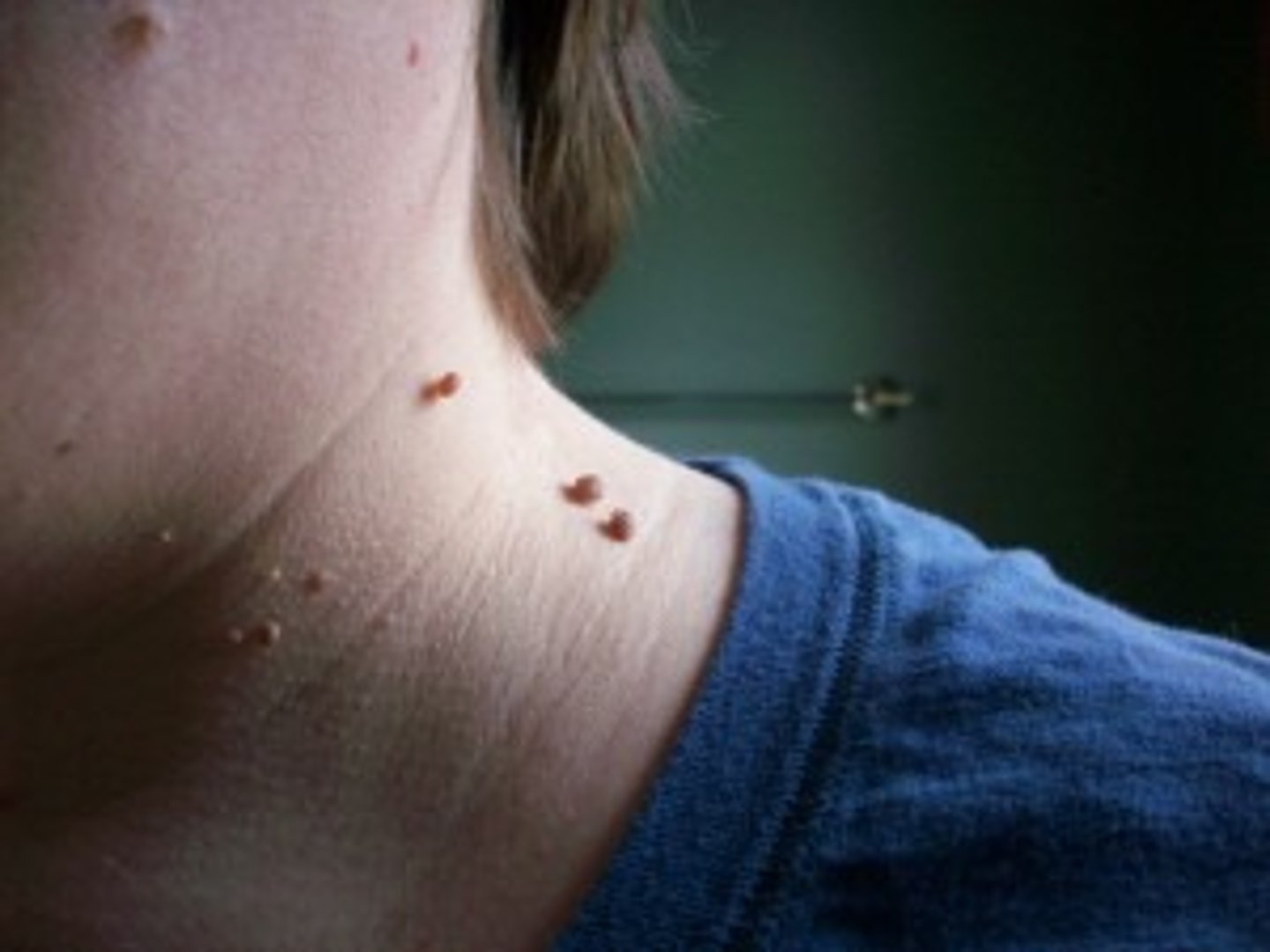 <p>A small brown-colored or flesh-colored outgrowth of the skin.</p>