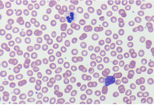 <p>What anemia does this peripheral blood smear indicate? </p>