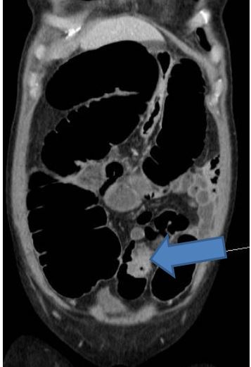 <ol><li><p>CT</p></li><li><p>povečan cekum (> 9 cm)</p></li><li><p>dilatacija cekuma</p></li><li><p>tumor (puščica)</p></li></ol><p></p>