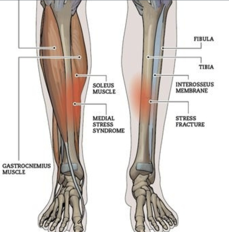 <p>What is the medical term for “shin splints”? What is the MOI and predisposing factors that can lead to shin splints?</p>