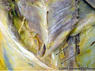 <p>what tendon is being indicated to by the probe in the image; context: transversus abdominis muscle has been reflected</p>