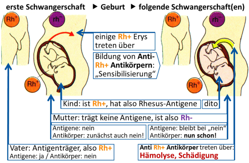 <ul><li><p>Es gibt drei Rh-Systeme: C, D, E, wobei D das wichtigste ist</p></li><li><p>Antigenträger heißen Rh-positiv (Rh+) und Nicht-Antigenträger sind Rh-negativ (Rh-)</p><ul><li><p>Besonderheit: Bei Rh-negativen Personen sind Antikörper gegen Rhesusantigene sind normalerweise NICHT vorhanden, sondern entstehen erst, wenn Blut von Rh+-Spendern auf Rh- -Empfänger übertragen wird (sog. Sensibilisierung)</p></li></ul></li><li><p>Bei der 1. Transfusion erfolgt diese Sensibilisierung, d.h. geringe Mengen von Rh-Antikörpern werden gebildet</p></li><li><p>Bei 2. Transfusion werden dann sofort große Mengen von Antikörpern gebildet --> Agglutination der Spendererythrozyten</p></li><li><p>Wichtig bei rhesusinkompatiblen Schwangerschaften (s. Folie)</p><ul><li><p>Vater: Rh+, Mutter: Rh-, 1. Kind: möglicherweise Rh+</p></li><li><p>Unter der Geburt kann eine geringe Menge des kindlichen Blutes mit Kindererythrozyten (Rh+) durch die Gebärmutter in den mütterlichen Blutkreislauf übertreten (Kind: Spender, Mutter: Empfänger), d.h. Mutter wird sensibilisiert</p></li><li><p>Falls 2. Kind ebenfalls Rh+, Problem, denn die mütterlichen Antikörper können durch die Plazenta (=Mutterkuchen) in den kindlichen Kreislauf übertreten (Dann dort: Rh+-Blut mit Rh-Antikörpern -->Agglutination, Morbus haemolyticus fetalis bzw. neonatorum)</p></li><li><p>Abhilfe: Anti-D-Propyhylaxe. Dabei erhält Mutter sofort nach der Geburt Anti-D-Antikörper, die die wenigen Kindererythrozyten sofort unschädlich machen, noch bevor eine Sensibilisierung stattfinden kann</p></li></ul></li></ul><p></p>