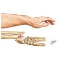<p>Fracture at the distal end of the radius that displaces the smaller fragment posteriorly</p>