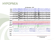 <p>C. hypopnea</p>
