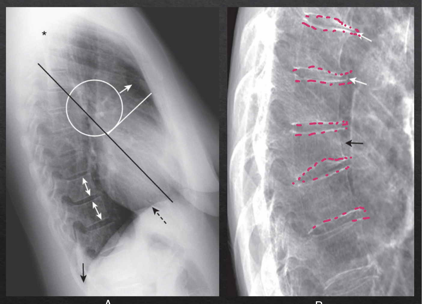 <p>NORMAL</p><ul><li><p>rectangular vertebra; bodies with parallel endplates</p></li><li><p>disk spaces maintain height from top to bottom of thoracic spine</p></li></ul><p>ABNORMAL</p><ul><li><p>narrowing of disc space</p></li><li><p>vertebral body loses height (compression fracture)</p></li><li><p>bony spurring</p></li></ul><p></p>