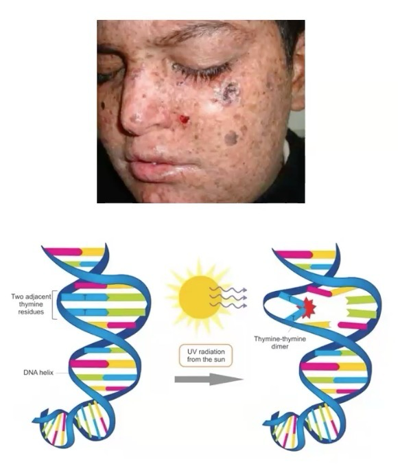 <p>Caused by mutation in XPA gene encoding protein for <strong>nucleotide excision repair (NER)</strong> which removes bulky DNA lesions like<strong> thymine dimers (UV rad)</strong>.</p><p>Causes accumulation of structural mutations in <strong>DNA helix</strong>. Greatly increases risk of skin cancer.</p>