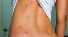 <p>-Bites are typically painless</p><p>-Erythematous papules, bullae and wheals may develop</p><p>-Liner bite patter on skin is well described with bed bugs and brown or black patterns of excrement may be found on bed linen.</p>