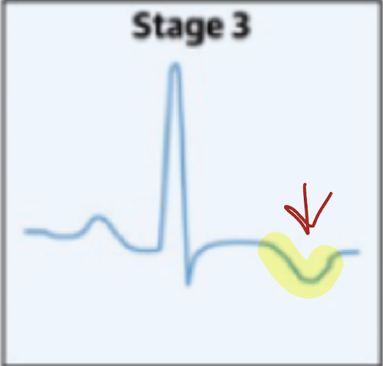 <p>T-wave inversion</p>