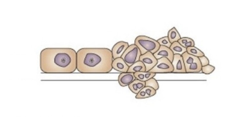 <p>Which cellular adaptation is this:</p><ul><li><p>Commonly called a tumor</p></li><li><p>Two types: benign and malignant</p></li></ul><p></p>