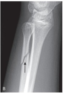 <p>direction of fracture line</p>