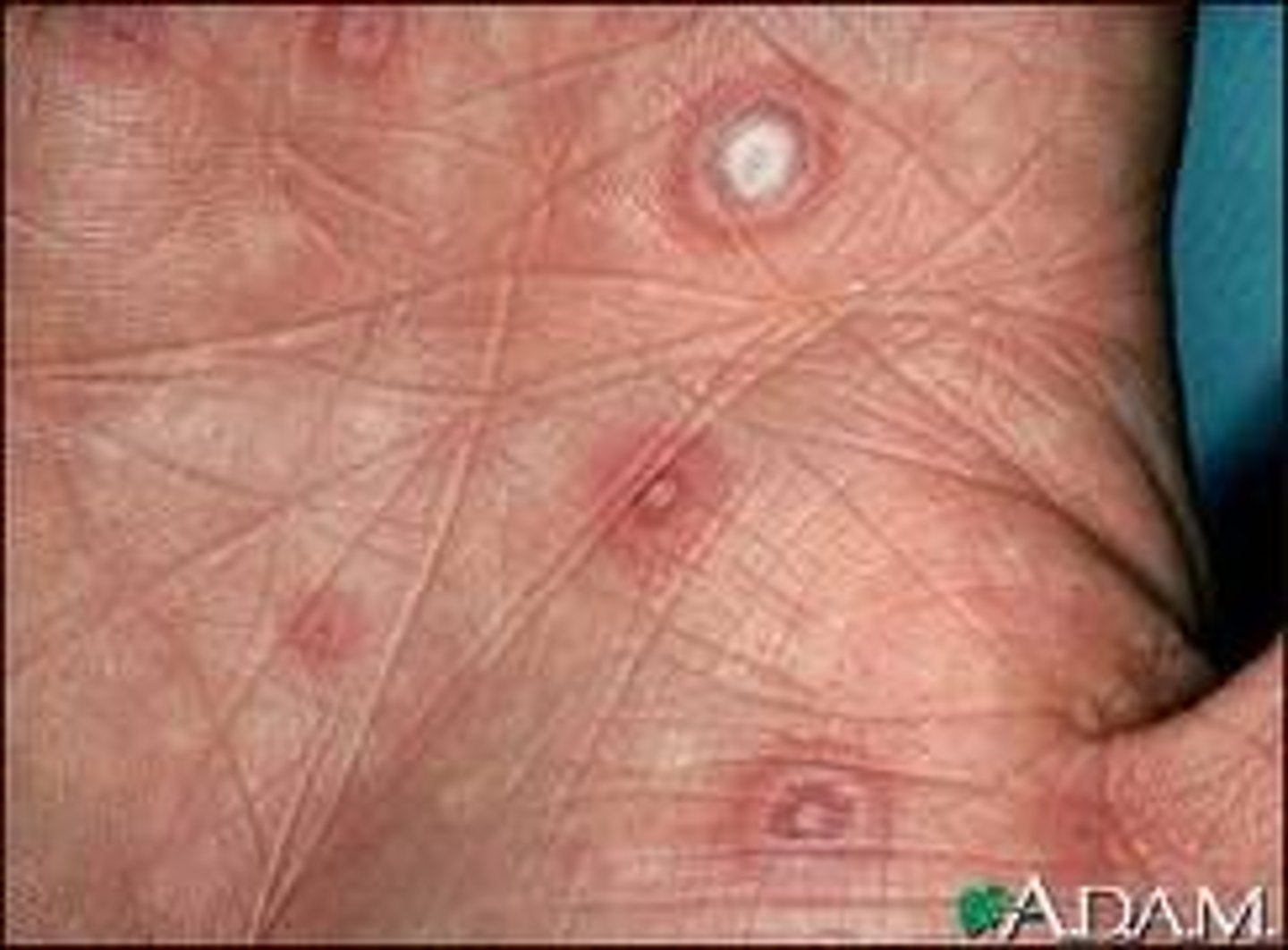 <p>Erythema multiforme is a target-like lesion associated with various infections - most commonly herpes simplex virus (HSV), medications (sulfa drugs), and other various triggers</p>