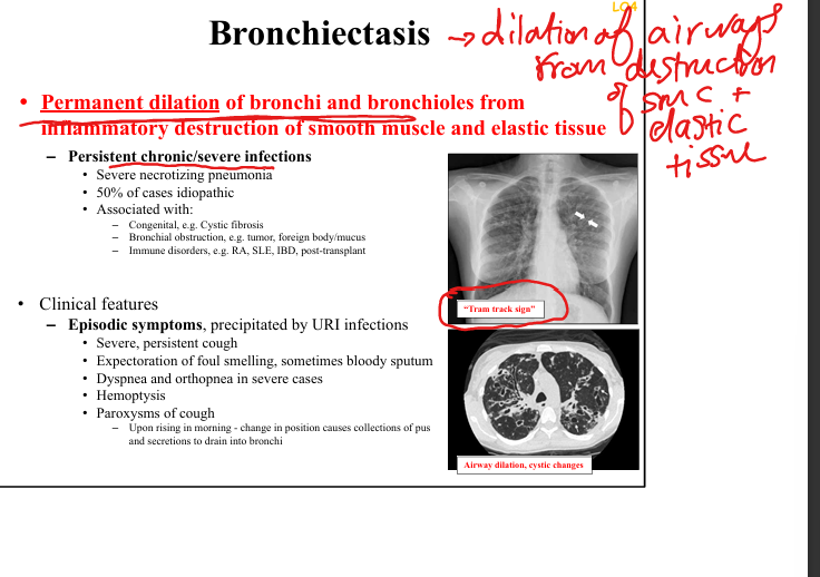 <p>Chronic obstruction + infection → impaired clearance → inflammation → airway wall destruction.</p><img src="https://assets.knowt.com/user-attachments/3edd3b13-e7a7-4a0e-b23d-73a53ae634d4.png" data-width="50%" data-align="center" alt="knowt flashcard image" style="display: block; width: 50%; margin-left: auto; margin-right: auto;"><p></p>