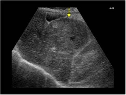 <ul><li><p>variable </p></li><li><p>solitary hypo mass</p></li><li><p>multiple heterogeneous masses </p></li><li><p>hypo halo around mass (bulls eye or target sign) </p></li><li><p>signs of cirrhosis or chr hepatitis </p></li></ul><p></p>