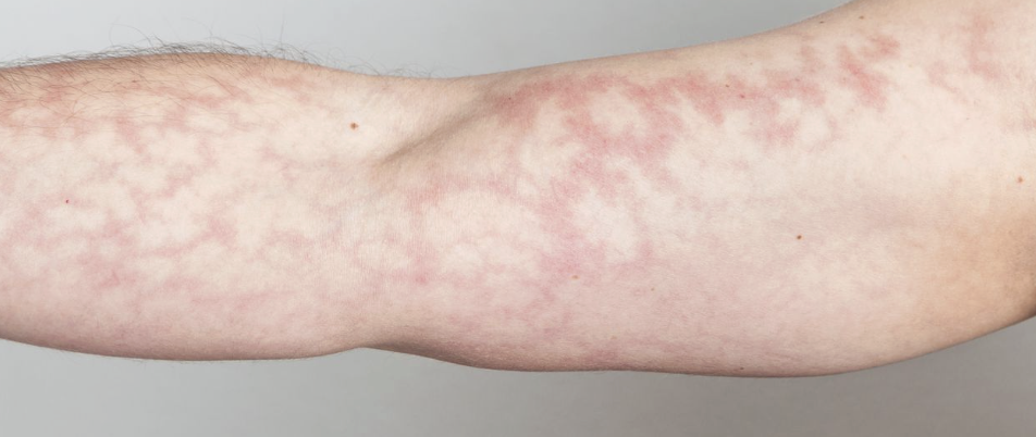<ul><li><p>mottling </p></li><li><p>edema </p></li><li><p>peripheral cyanosis </p></li><li><p>cool extremities</p></li><li><p>weak or absent pulses → late stage</p></li><li><p>hypotension</p></li><li><p>tachycardia </p></li></ul><p></p>