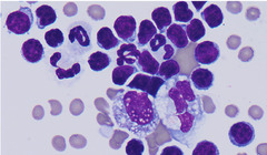 <p>A 4 year old female domestic short hair presented with tachypnea and shallow breathing. There are muffled heart and lung sounds ventrally. You find the triglyceride count to be higher in the effusion than serum. This is what cytology shows. What type of effusion is it?</p>