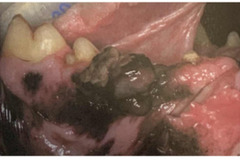 <p>This malignant tumor typically occurs in the gingiva, buccal/labial mucosa, and tongue, appearing as a gray/brown/black mass which is ulcerated, friable, and easily bleeds. Gast growing and commonly causes necrosis</p>