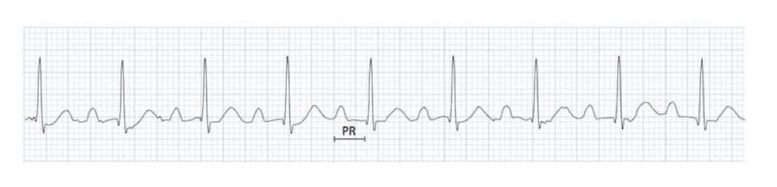 <p>What rhythm/abnormality is seen below?</p>
