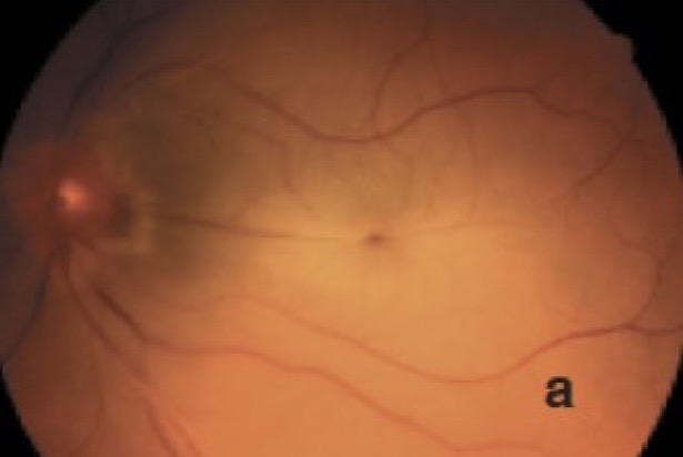 <p><span>Un homme de 80 ans, diabétique et hypertendu, se présente avec une perte subite de la vision de l'oeil gauche il y a 3 heures. Son acuité visuelle est </span><em><span>Perception lumineuse</span></em><span>, il y a un déficit pupillaire afférent de l'oeil gauche. Quelle est l'étiologie la plus probable ?</span></p><p></p><p><span>A. Occlusion de la veine centrale de la rétine</span></p><p><span>B. ﻿﻿﻿Rétinopathie hypertensive</span></p><p><span>C. ﻿﻿﻿Rétinopathie diabétique proliférante</span></p><p><span>D. Occlusion de l'artère centrale de la rétine</span></p><p></p>