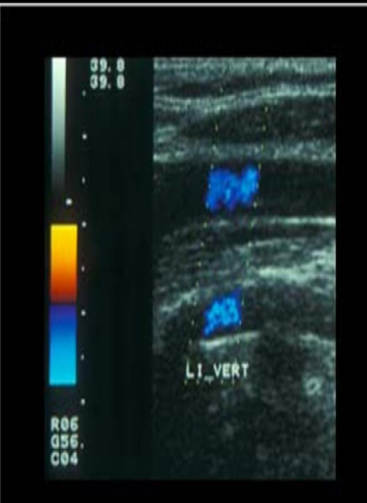 <p>what is demonstrated on the image?</p>