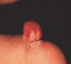 <p>pyogenic granuloma</p>