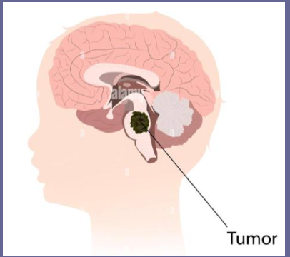 <ul><li><p>tumor that arises form <strong>glial cells in brainstem</strong>, typically <strong>pons</strong></p></li></ul><p></p>