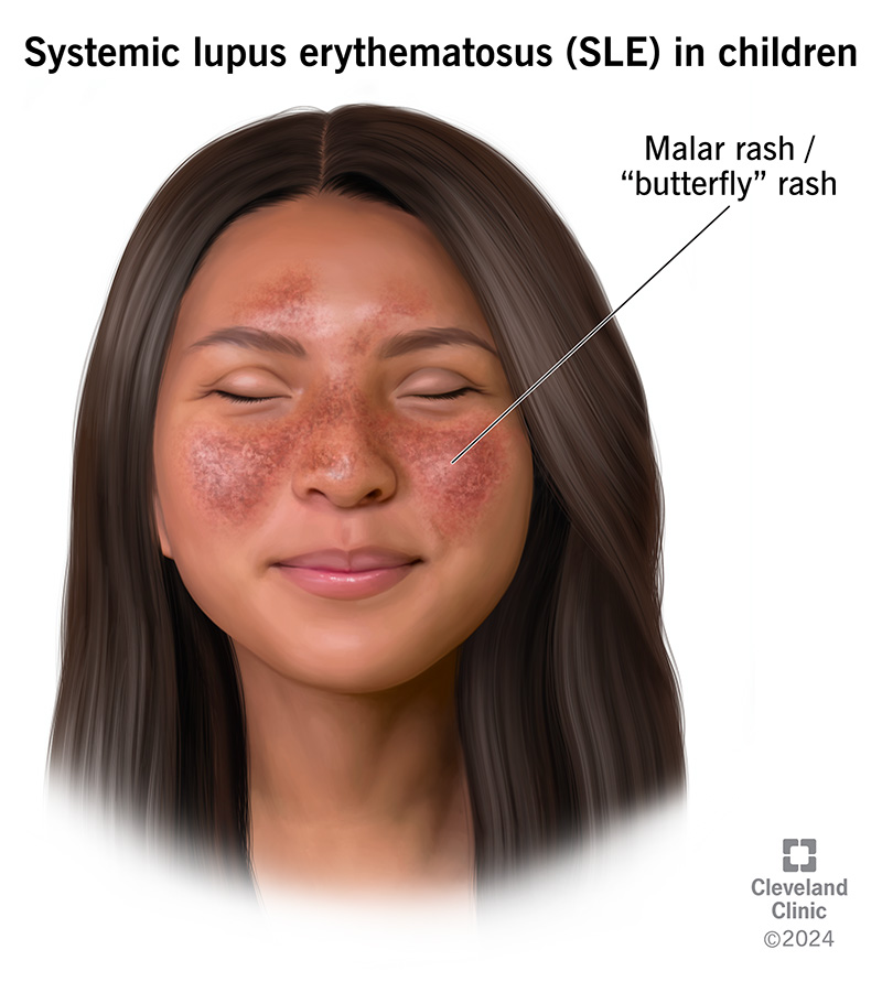 <p>Supports Active SLE diagnosis and some drug induced lupus syndromes</p>