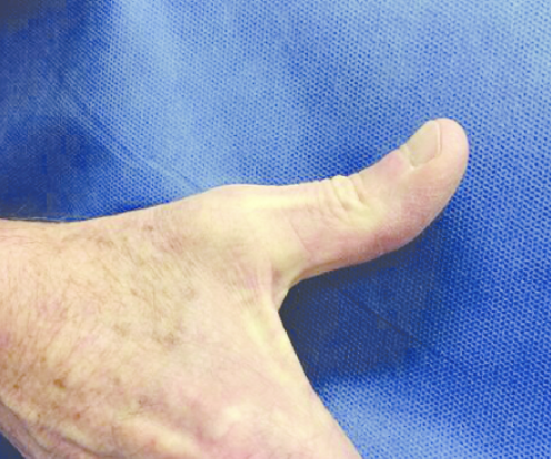 <p>thumbs up (MP and IP)</p>