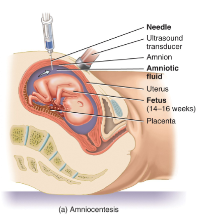 <ul><li><p>involves removing some amniotic fluid surounding the developing fetus, &amp; analyzing it &amp; fetal cells for genetic abnormalities</p></li><li><p>needle used to collect the fluid is guided by ultrasound to avoid damage to fetus or umbilical cord</p></li></ul><p></p>