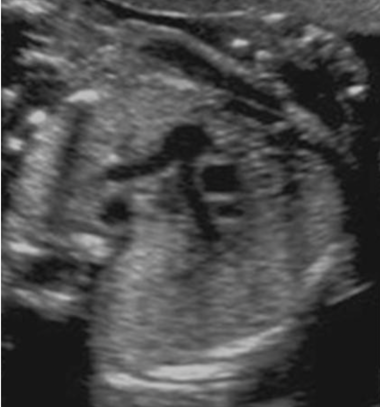<p>Locate the right pulmonary artery</p>
