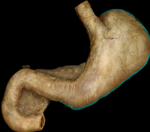 <p>left and inferior border of stomach, attached to the greater omentum</p>