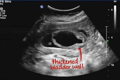 <ul><li><p>bladder wall severely thickened with dilated posterior urethra</p></li><li><p><span style="color: red;">“keyhole sign”</span></p></li><li><p>bladder wall thickening</p></li><li><p>marked bilateral hydronephrosis and dilated tortuous ureters</p></li><li><p>occurs only in male fetuses</p></li><li><p>diminishing AFI</p></li></ul><p></p>